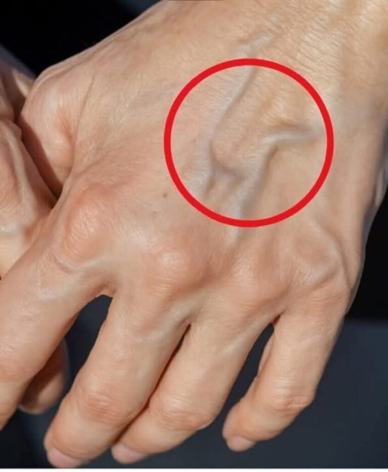 1-TG If you have visible veins it means you are…See more
